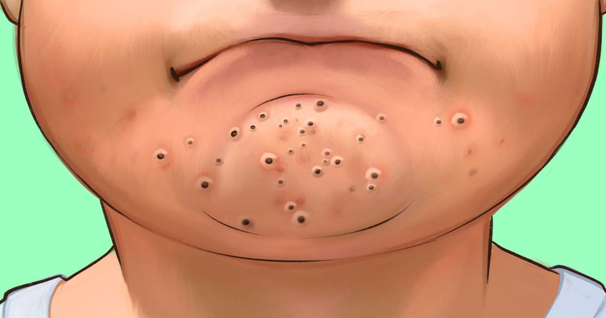 How to Get Rid of Chin Blackheads Once and For All