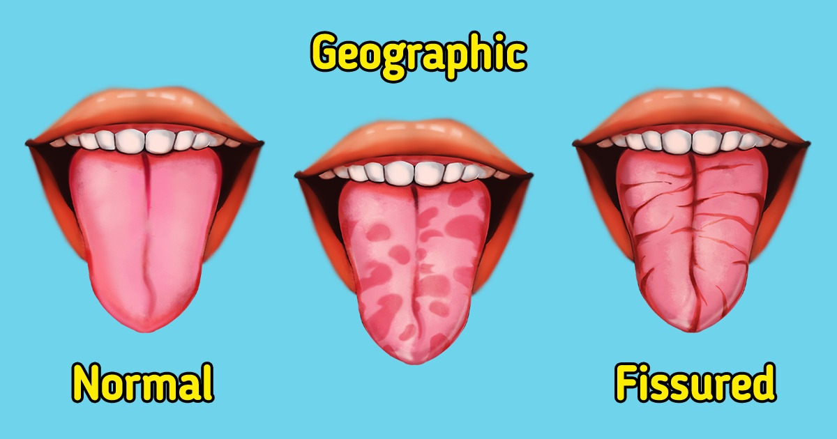 What A Geographic And Fissured Tongue Is 5 Minute Crafts
