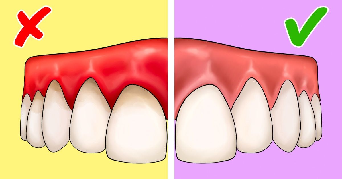 How to Take Care of Your Gums / 5Minute Crafts