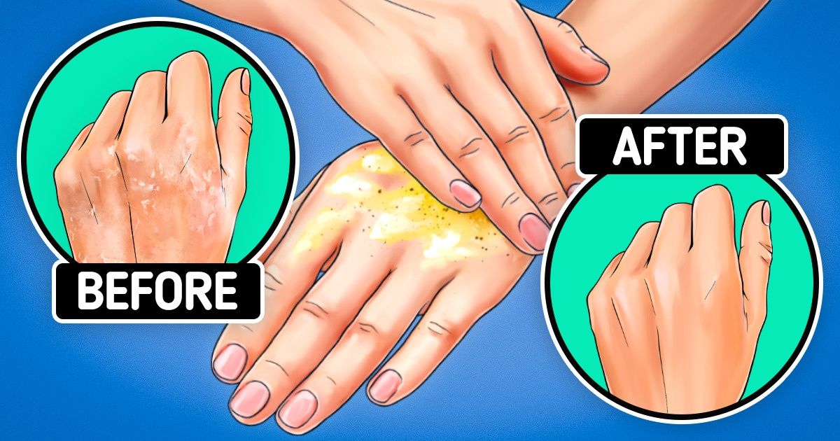How to Treat Dry Hands