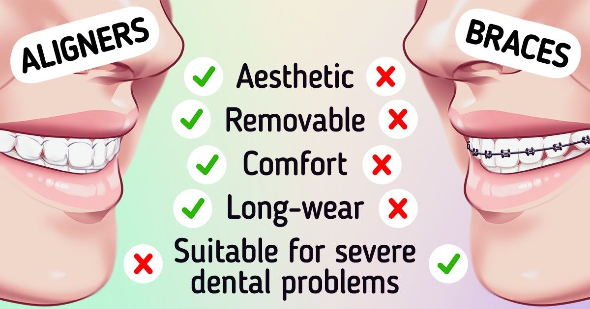 What the Difference Between Braces, Aligners, and Plates Is / 5-Minute ...