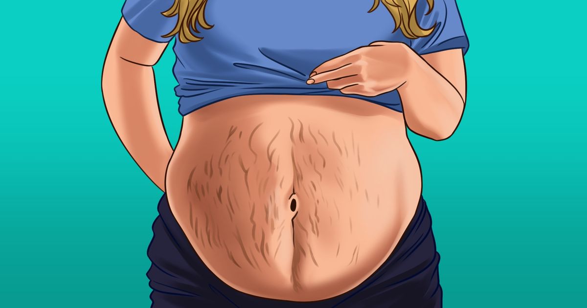 How to Get Rid of Stretch Marks